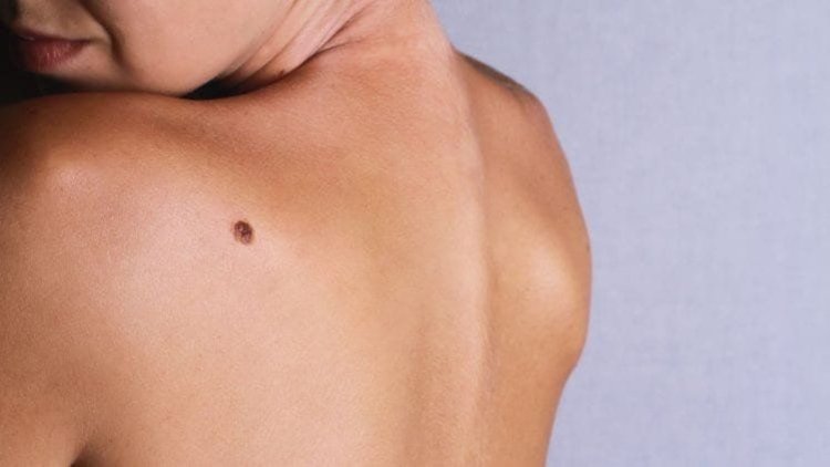 Самонаблюдението на бенките е важно, за да се предпазим от рак на кожата